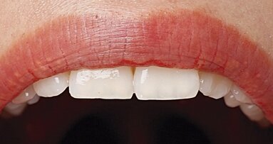 El paciente con cáncer oral: Guía clínica para su atención odontológica (3)