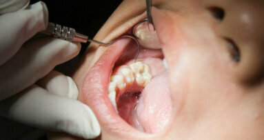 Individuati dalla ricerca vari trattamenti per la sigillatura dei denti