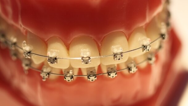 Fałszywe aparaty ortodontyczne szkodzą zdrowiu