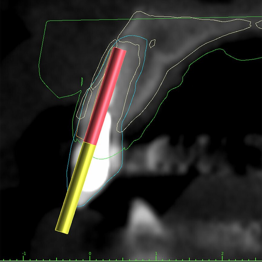 Fig. 3a: Planning the initial drill path using a custom implant design (red) to match the
diameter of the initial drill to reach the tooth apex. The abutment projection is shown in yellow.