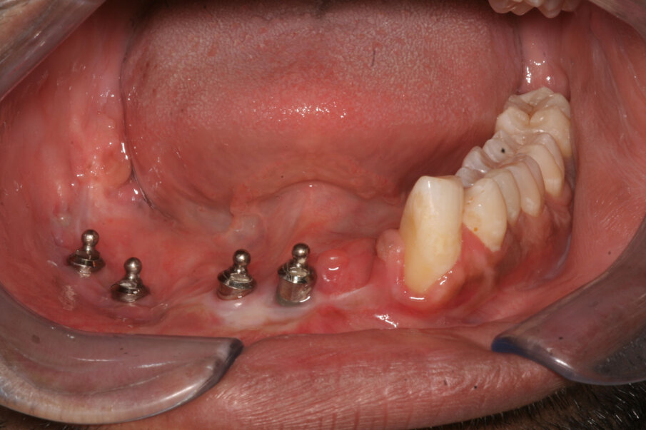 Fig 3: Clinical intraoral picture of the same patient. Note the presence of healthy keratinised mucosa around implants in the mandible reconstructed by the free fibula flap.