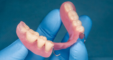 Răng giả tháo lắp một phần có thể cải thiện tỷ lệ tử vong ở người trưởng thành mất răng một phần