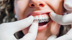 Ensuring predictable results in clear aligner therapy