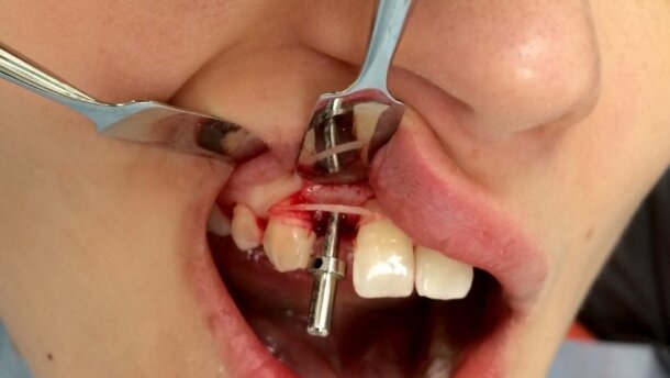 Zespołowe leczenie ortodontyczno-chirurgiczno-protetyczne pacjenta z hipodoncją