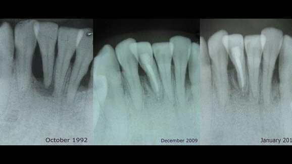 牙菌斑或可用于疾病的预测与治疗