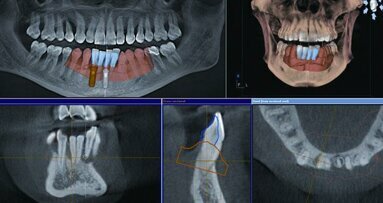 CBCT-assisted implant therapy: A case study