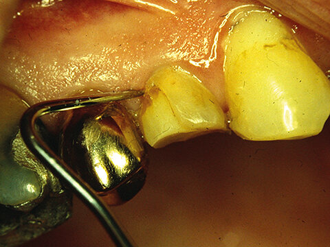Fig 1. Blood stain at the marginal third of a composite resin filling in a premolar, accompanied with a 1-mm gap at the gingival margin. The restoration is less than 6 months old. Photo by Leo Tjäderhane