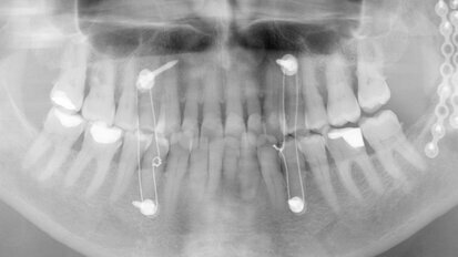 Unilateral occlusal elevation with a lithium disilicate onlay and a zirconia bridge