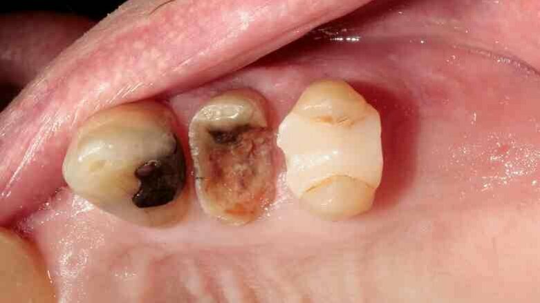 Atraumatic extraction of maxillary first premolar