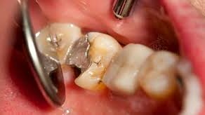 Amalgames dentaires à base de mercure : Recommandations de l’ANSM pour les professionnels de santé