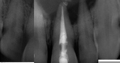 Large periapical lesion management: Decompression combined with root-canal treatment