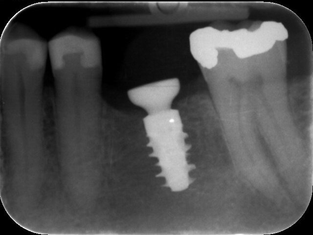Fig. 6: Radiograph confirming the seating of a healing abutment of 6.5 mm in diameter and 1.5 mm in gingival height.