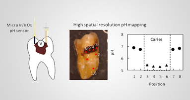 New microsensor for pH mapping joins the fight against dental caries