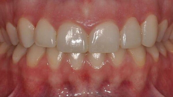 Enhancement of aesthetic treatment planning and communication using a diagnostic mock-up