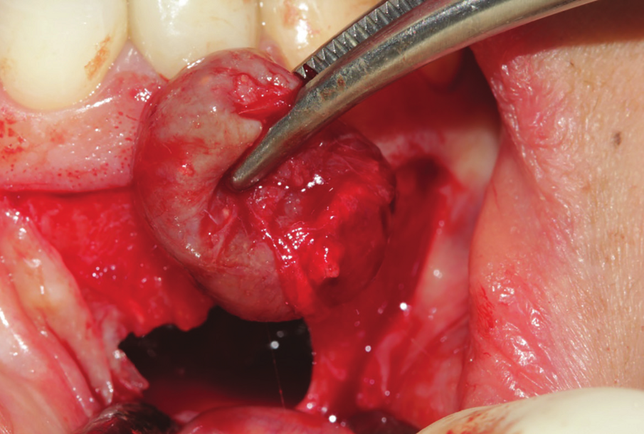 Figure 23: Enucleation of the 1.5 cm lesion followed by extraction of endodontically perforated tooth no 7.