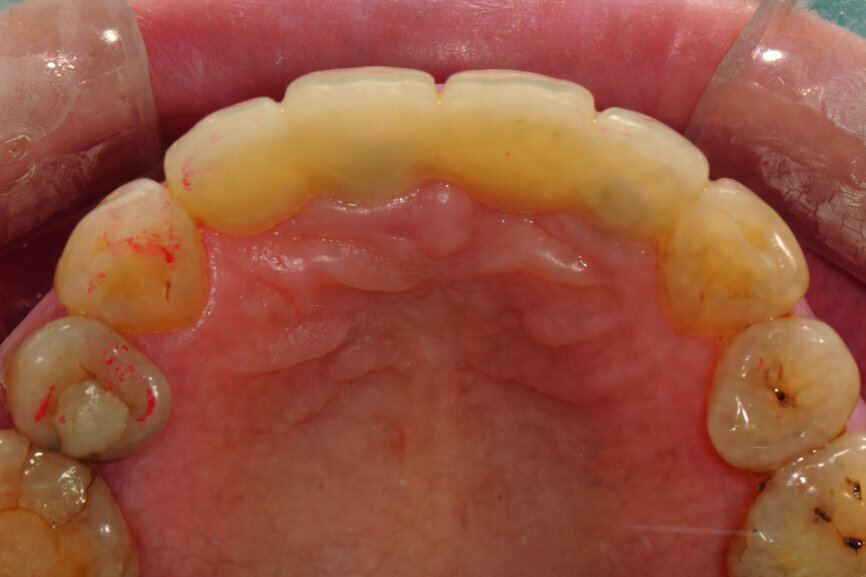 Fig. 23: Lateral guidance on tooth #13 after reshaping of the lingual surface with resin (12 μm occluding paper, red).