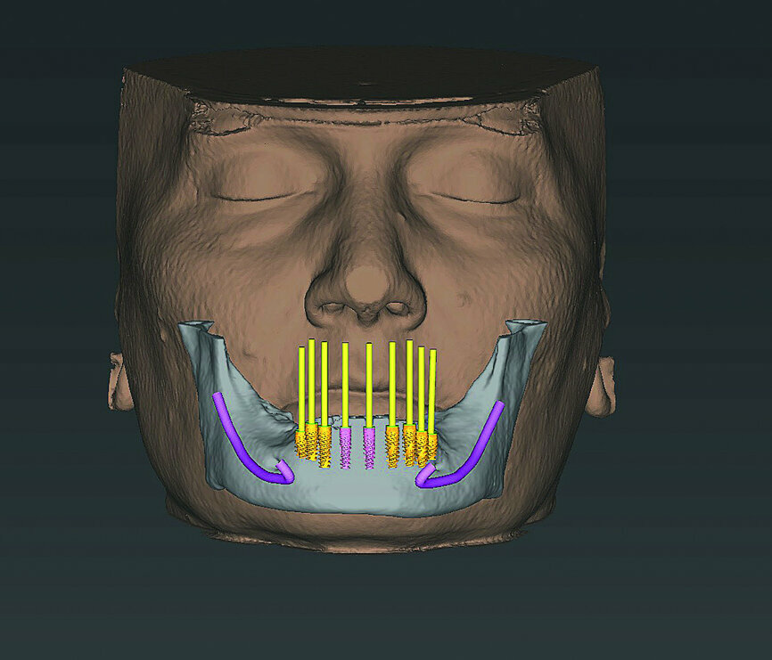Fig. 6: Dentofacial analysis of proposed implants in mandibular arch.