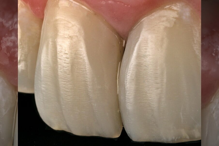 Fig. 16: Direct Aesthetic veneer restorations completed on tooth 11 & 21.