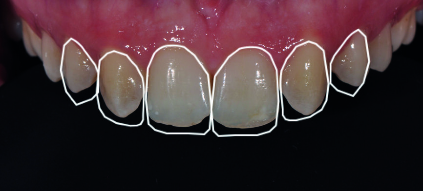 Fig. 2 : Conception numérique du sourire (DSD) des deux formes dentaires souhaitées. 