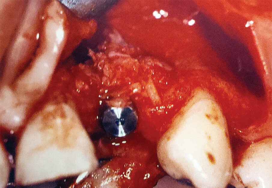 Fig. 7: Placement of ‘gummy bone’ over exposed implant threads at implant placement that will allow the osseous graft to remain where needed as the bone heals and prevent dispersement found when particulate graft is used alone.