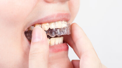 Novo revestimento previne  crescimento de bacteria em aparelhos dentais
