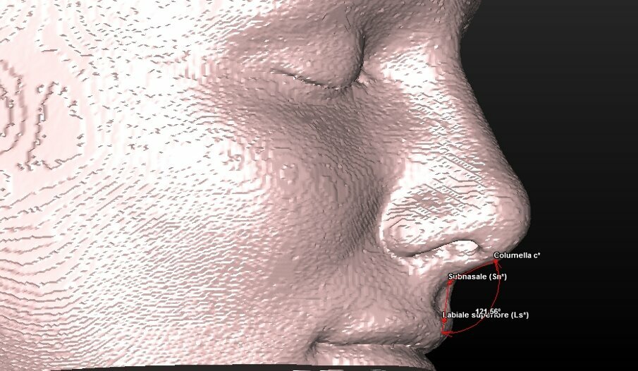Fig. 10a_Valutazione dei tessuti molli: angolo naso-labiale.