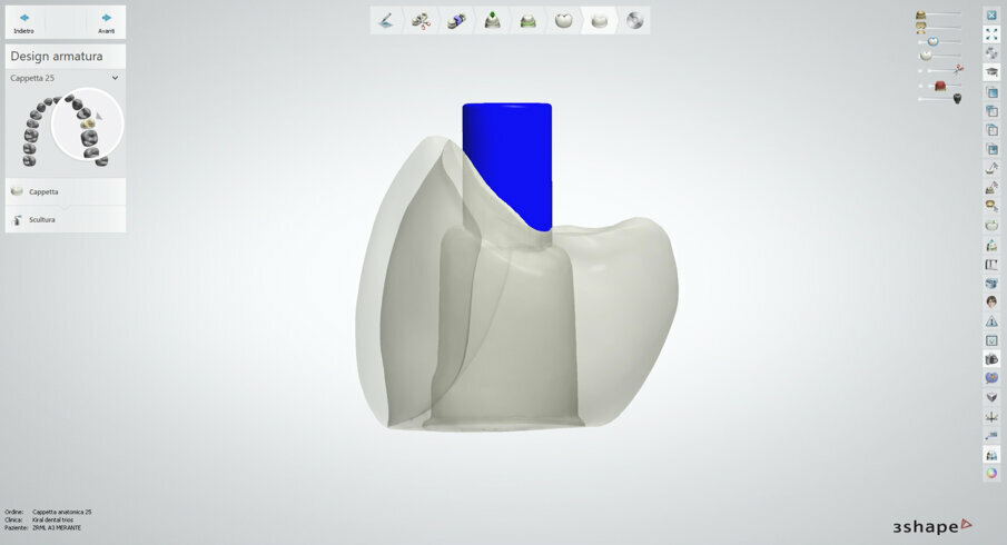 Fig. 8 - Stabilito il progetto implantoprotesico e scelto il materiale, si decide di esaltare l’estetica simulando l’addizione ceramica. Si procede nel progetto con una porzione vestibolare in sottrazione nel volume adeguato.
