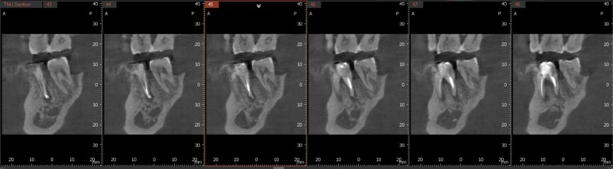 Fig. 6a: Post-op CBCT images of tooth #46 showing adequately obturated canals at all levels to the working length and sealing of the furcation defect.