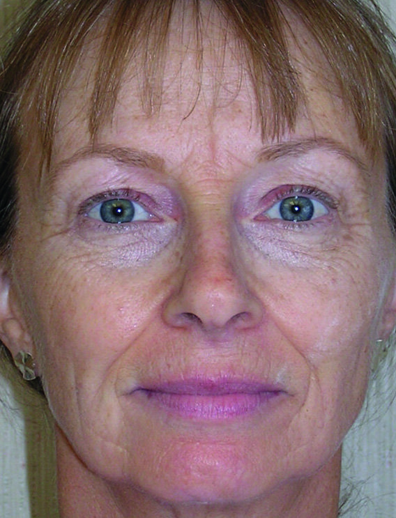 Fig.3 : Prétraitement facial, post-traitement facial six mois et neuf mois après, et enfin, évaluation morphométrique du changement.