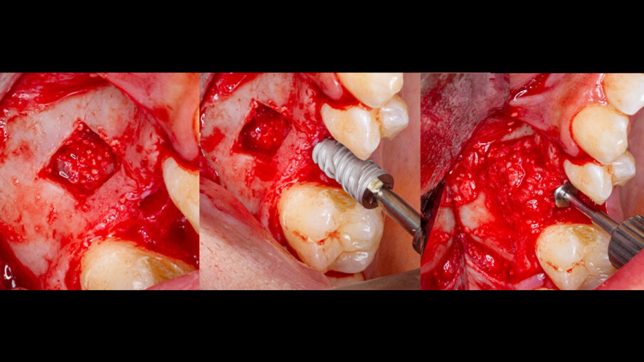 Obr. 3a–c: Snímky z průběhu zákroku – rekonstrukce kosti a zavedení implantátu.