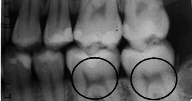Οι οδοντιατρικές ακτινογραφίες μπορούν να αποκαλύψουν έλλειψη βιταμίνης D