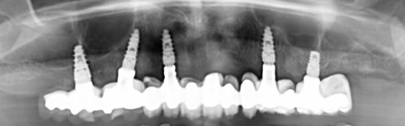 Fig. 7_Radiografia panoramica a tre anni dall’intervento in cui si apprezza il mantenimento dei livelli ossei peri-implantari.