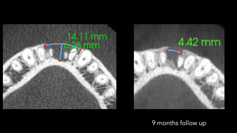 Slike 5a i b: Poređenje horizontalnih prikaza i-CAT skeniranja snimljenih pre operacije (a) i nakon devetomesečnog praćenja (b)