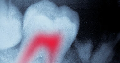 Une étude révèle que la douleur post-traitement endodontique a différentes sources