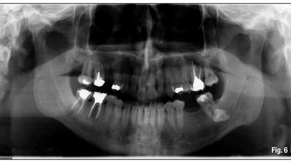 Cutaneous sinus tracts: An endodontic approach
