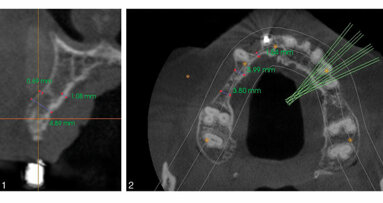 Comparing graft techniques for the alveolar ridge prior to implant