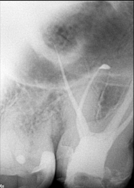 Fig. 7a: Immediate post-op radiographs showing 3D filling of the root canal system at different angulations.