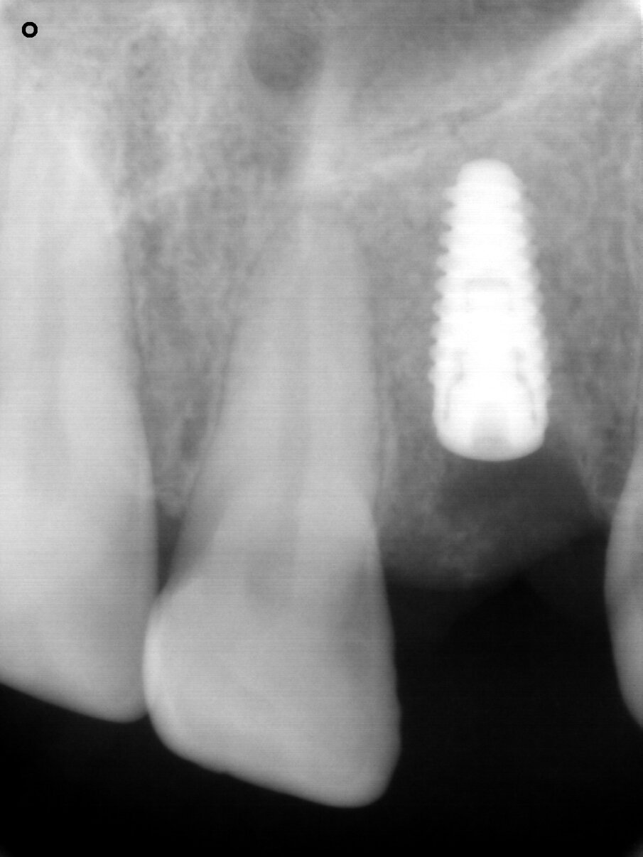 Fig. 7: Radiograph after placement of the implant, showing the stable socket bone site.