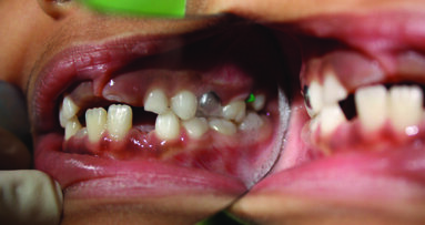 Management Of Ectopically Erupted First Permanent Molars