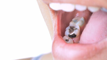 European Parliament bans dental amalgam