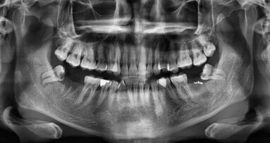 Well-known age assessment using third molars is not scientifically backed, says study