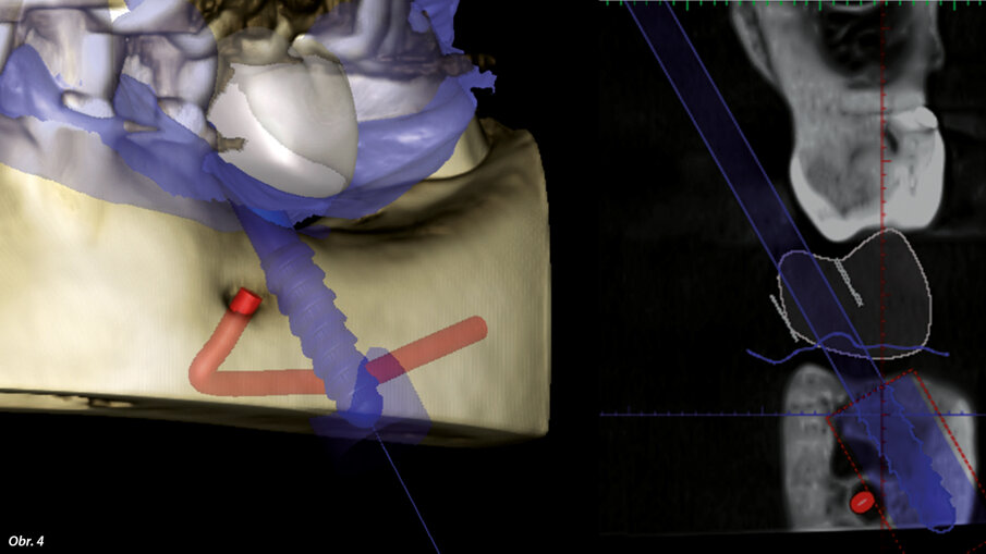 Plánovaná pozice implantátu BioniQ v blízkosti mandibulárního kanálu.