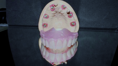 An implant-supported prosthetic restoration concept for edentulous atrophied maxillae