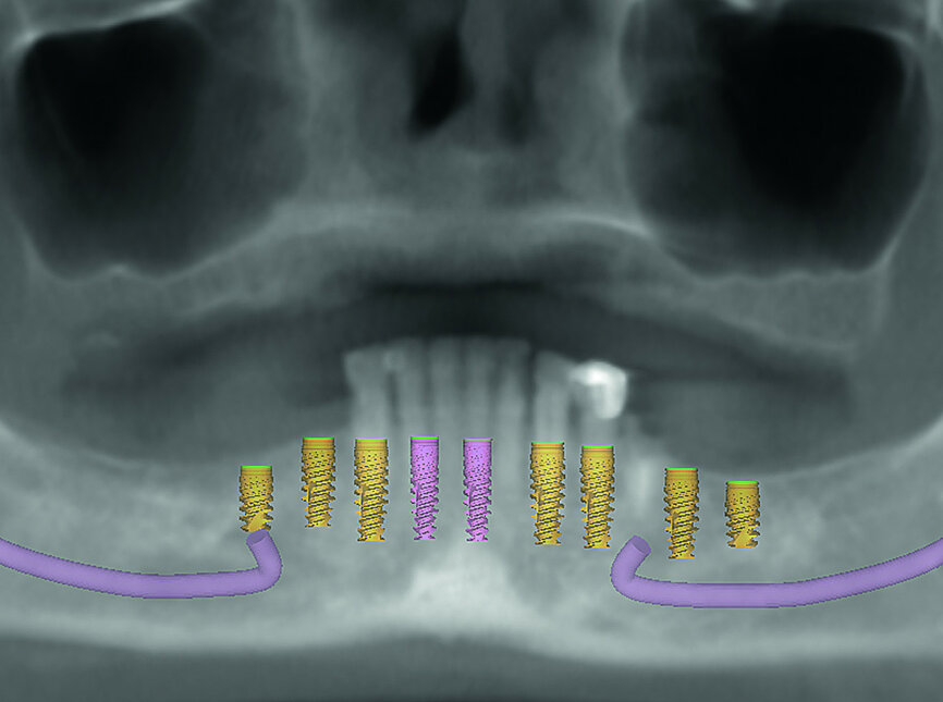 Fig. 4: Proposed treatment of mandibular arch.