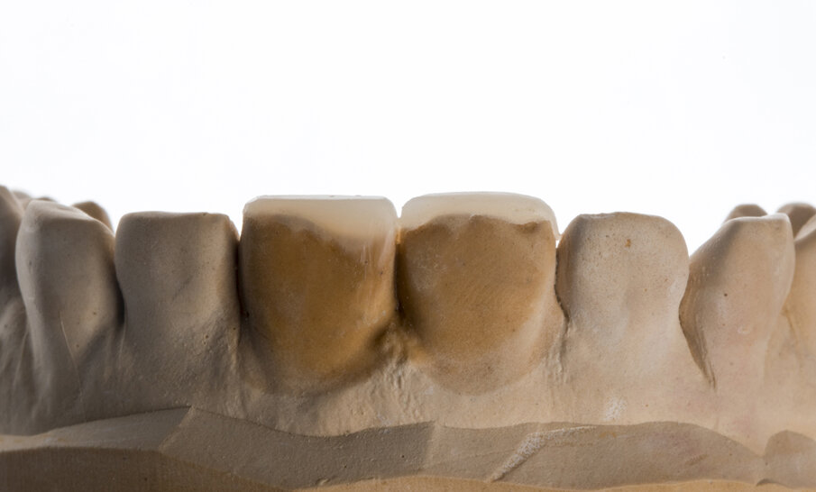 Fig. 3: Buccal view of the composite build-up on the tooth model, showing differences of a fractured incisal edges