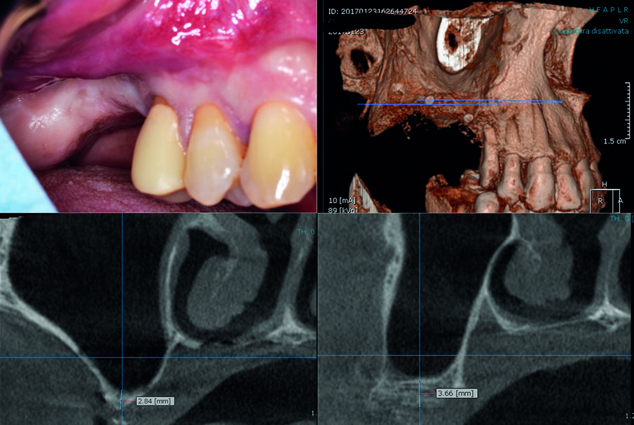 Fig. 1 - Aspetto clinico e radiografico dell’arcata superiore destra del paziente alla prima visita. La zona corrispondente agli elementi 1.6 e 1.7 presente una grave atrofia ossea verticale. 