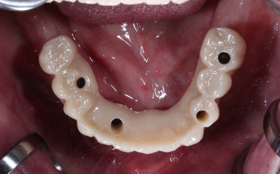 Fig. 22: Final mandibular prosthesis, occlusal view.
