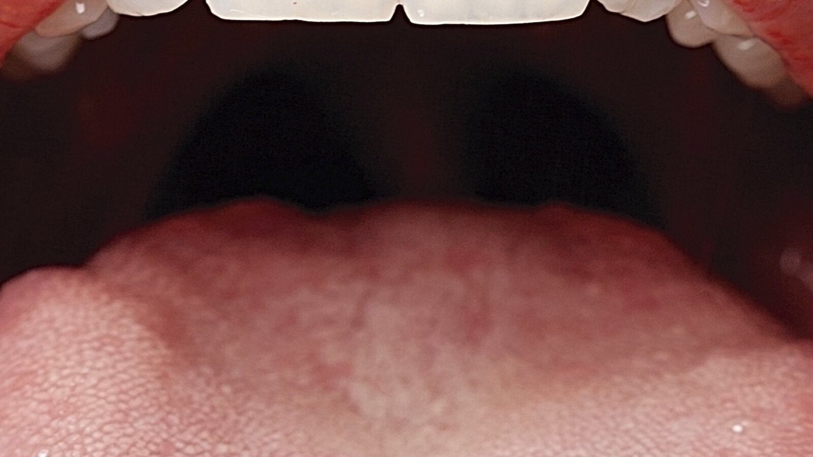 Guía Clínica para la atención odontológica del paciente con cáncer oral (4)