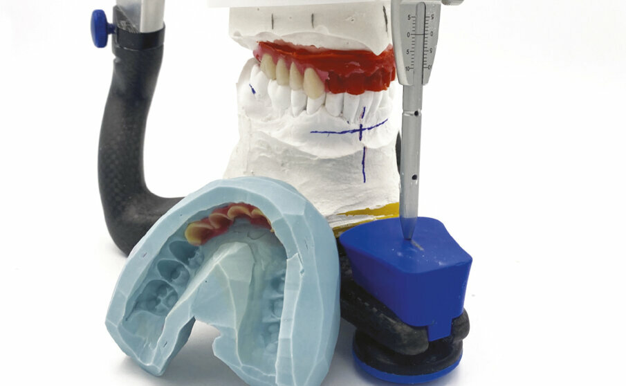 Fig. 10 - Realizzazione della protesi definitiva.