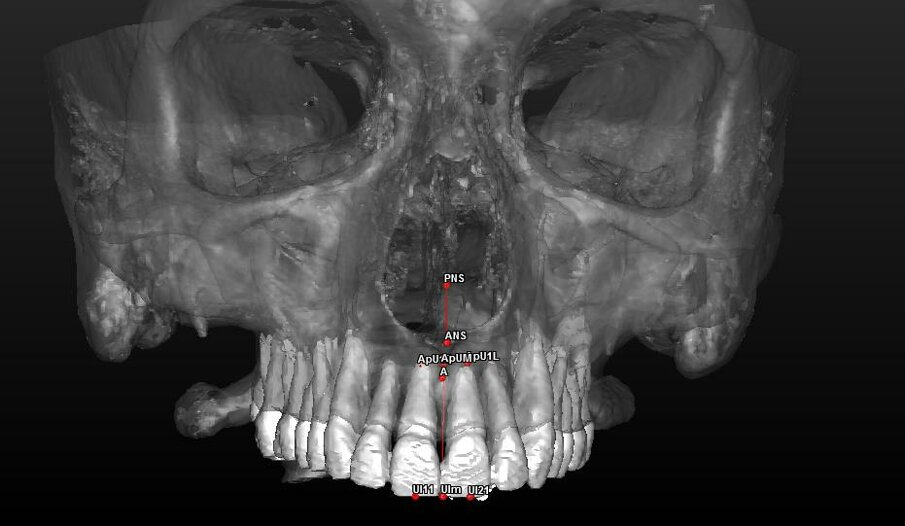 Fig. 2_Ricostruzione 3D del mascellare superiore ed arcata dentaria con visione frontale dei landmark utilizzati.